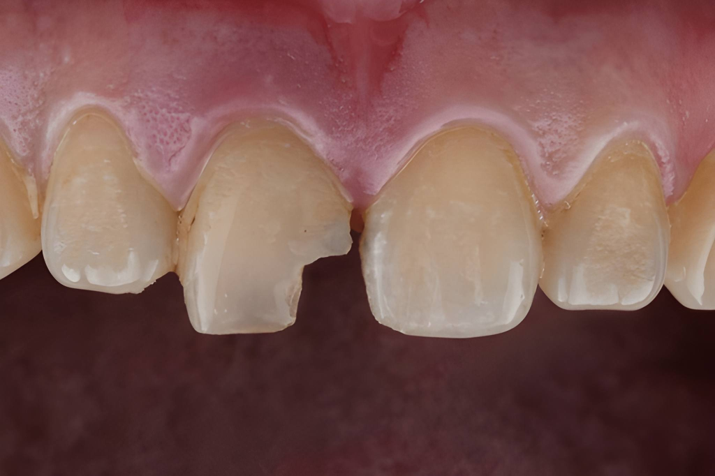 chipped tooth treatment in calgary