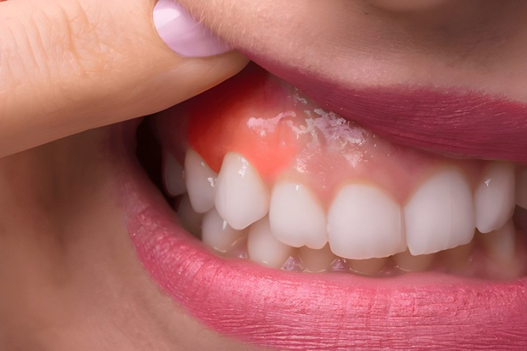 dental swelling treatment in calgary