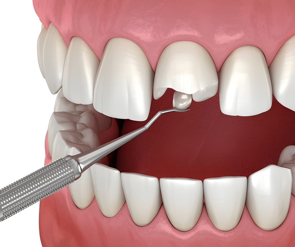 lost dental filling treatment in calgary
